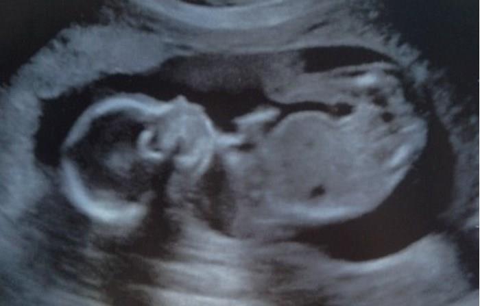 Judge Lets Abortion Clinics Deny Women Ultrasound