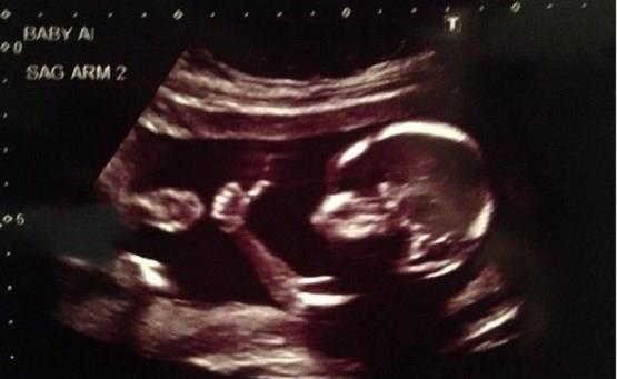 House Passes Bill Banning Abortions After 15-Weeks