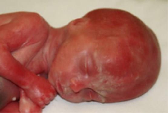 Canada: 766 Aborted Babies Born-Alive And Left-to-Die