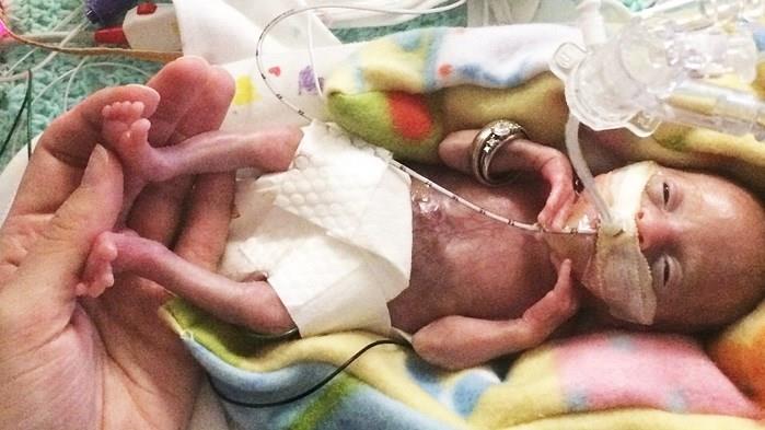 Premature Baby Born 21 Weeks Youngest Ever